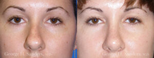 Patient 14b Rhinoplasty Before and After