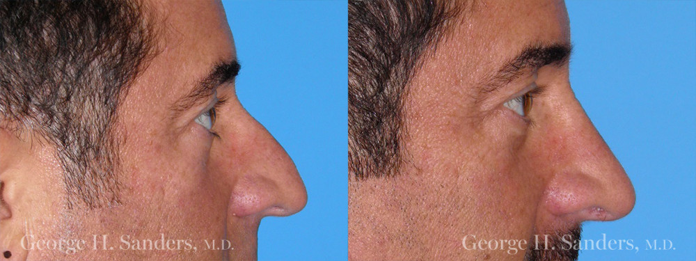 Patient 1a Rhinoplasty Before and After