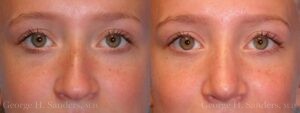Patient 21c Rhinoplasty Before and After