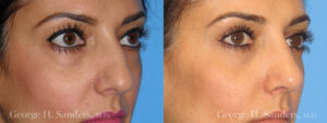 Patient 3b Rhinoplasty Before and After