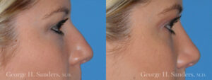 Patient 4a Rhinoplasty Before and After