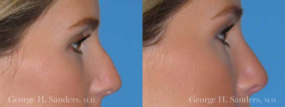 Patient 5a Rhinoplasty Before and After