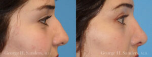 Patient 6a Rhinoplasty Before and After