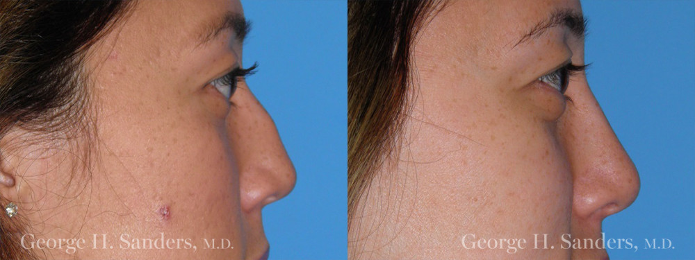 Patient 8a Rhinoplasty Before and After