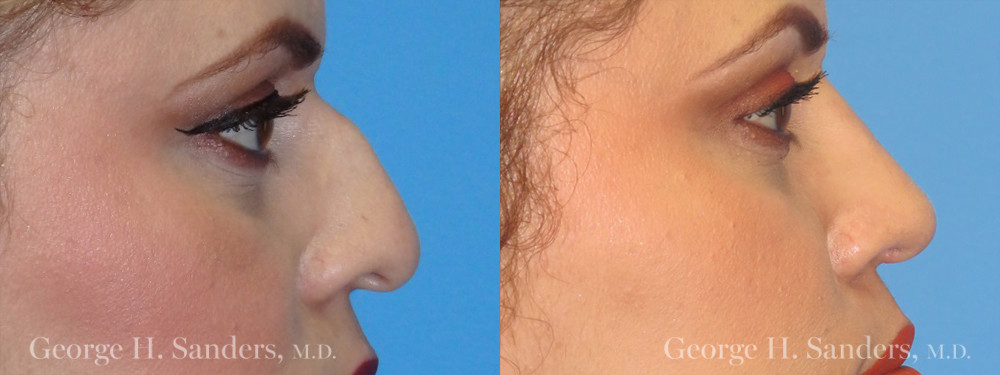 Patient 9a Rhinoplasty Before and After