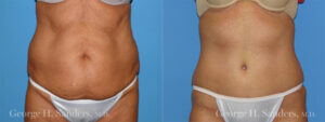 Patient 1a Tummy Tuck Before and After