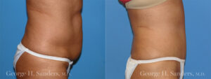Patient 1b Tummy Tuck Before and After