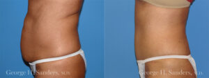 Patient 1c Tummy Tuck Before and After