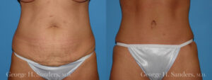 Patient 10a Tummy Tuck Before and After