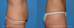 Patient 10b Tummy Tuck Before and After