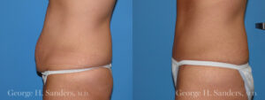 Patient 10c Tummy Tuck Before and After
