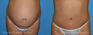 Patient 11a Tummy Tuck Before and After