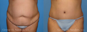Patient 13a Tummy Tuck Before and After