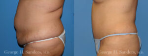 Patient 13b Tummy Tuck Before and After