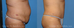 Patient 13c Tummy Tuck Before and After