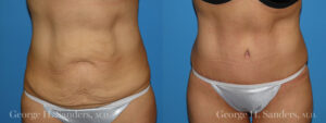 Patient 14a Tummy Tuck Before and After