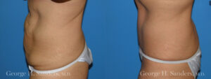 Patient 14b Tummy Tuck Before and After