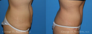 Patient 14c Tummy Tuck Before and After