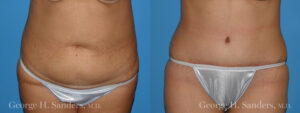 Patient 15a Tummy Tuck Before and After