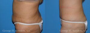 Patient 15b Tummy Tuck Before and After