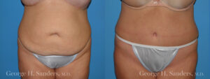 Patient 16a Tummy Tuck Before and After