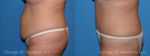Patient 16b Tummy Tuck Before and After