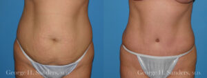 Patient 17a Tummy Tuck Before and After