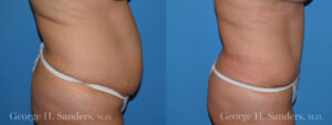Patient 17b Tummy Tuck Before and After