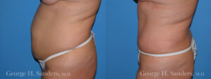 Patient 17c Tummy Tuck Before and After