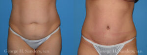 Patient 19a Tummy Tuck Before and After