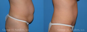Patient 19b Tummy Tuck Before and After