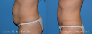 Patient 19c Tummy Tuck Before and After