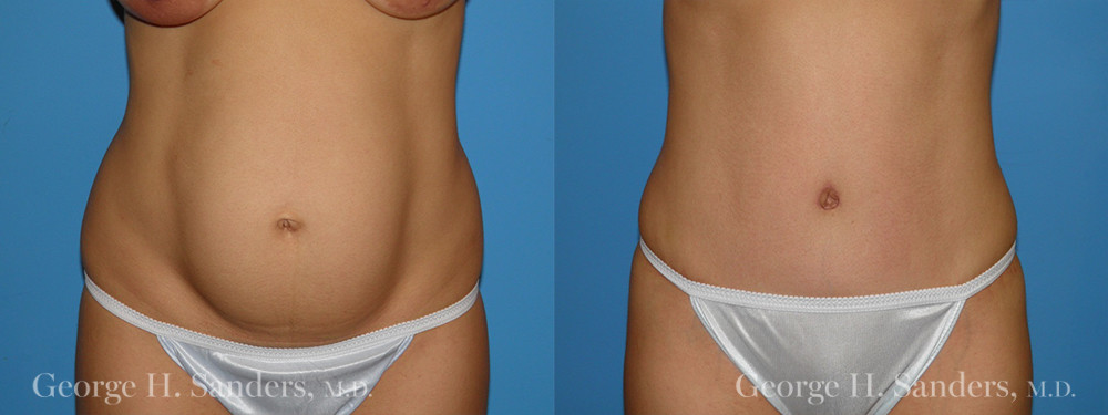 Patient 2a Tummy Tuck Before and After