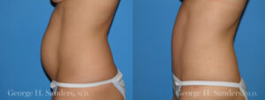 Patient 2c Tummy Tuck Before and After