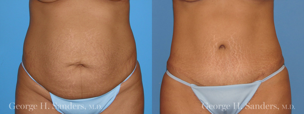 Patient 3a Tummy Tuck Before and After