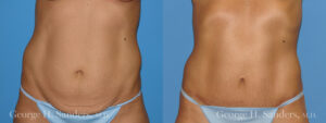 Patient 4a Tummy Tuck Before and After