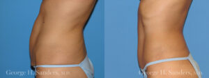 Patient 4b Tummy Tuck Before and After