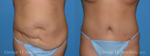 Patient 6a Tummy Tuck Before and After