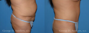 Patient 6b Tummy Tuck Before and After