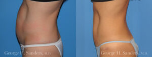 Patient 7b Tummy Tuck Before and After