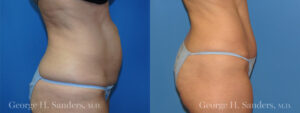 Patient 8b Tummy Tuck Before and After