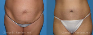 Patient 9a Tummy Tuck Before and After
