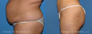 Patient 9b Tummy Tuck Before and After
