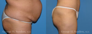 Patient 9c Tummy Tuck Before and After