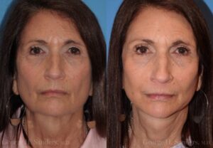 dr-sanders-san-fernando-valley-face-lift_Patient-19-1