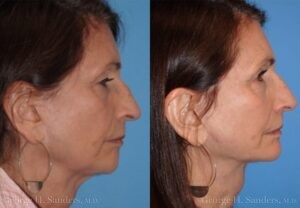 dr-sanders-san-fernando-valley-face-lift_Patient-19-2