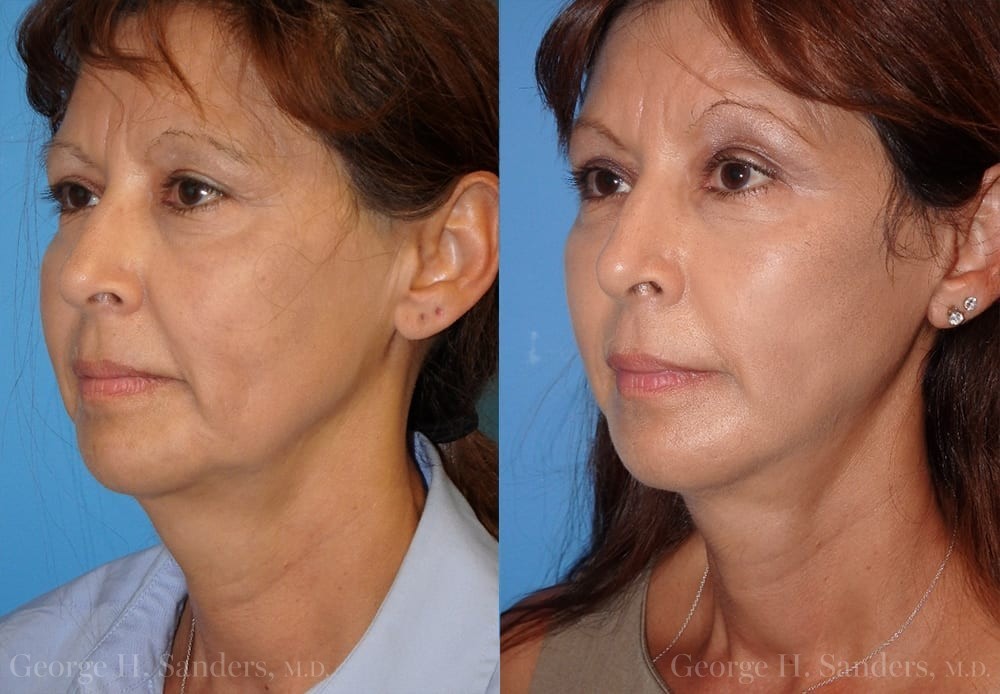 Patient 16b Face Lift Before and After