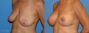 Patient 8b Breast Lift Before and After