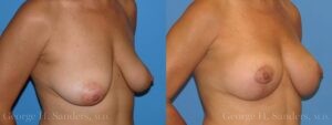 Patient 8c Breast Lift Before and After