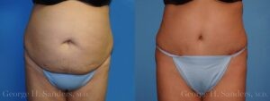 Patient 20a Tummy Tuck Before and After